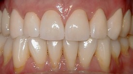 After upper arch rehabilitation
