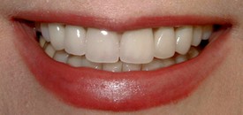 After upper anterior crowns