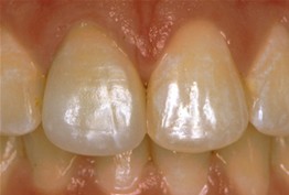 After dental restoration