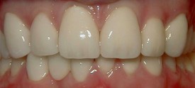 After upper anterior crowns