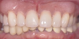 After upper and lower arch rehabilitation