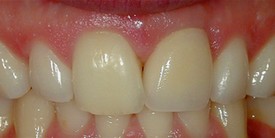 After single tooth replacement