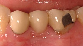 Before porcelain bridge restoration