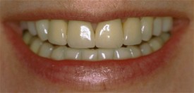 Before upper anterior crowns