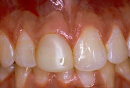 Before dental restoration