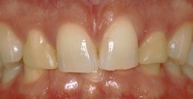 Before upper anterior crowns