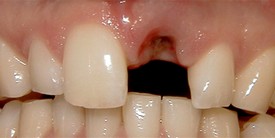 Before single tooth replacement